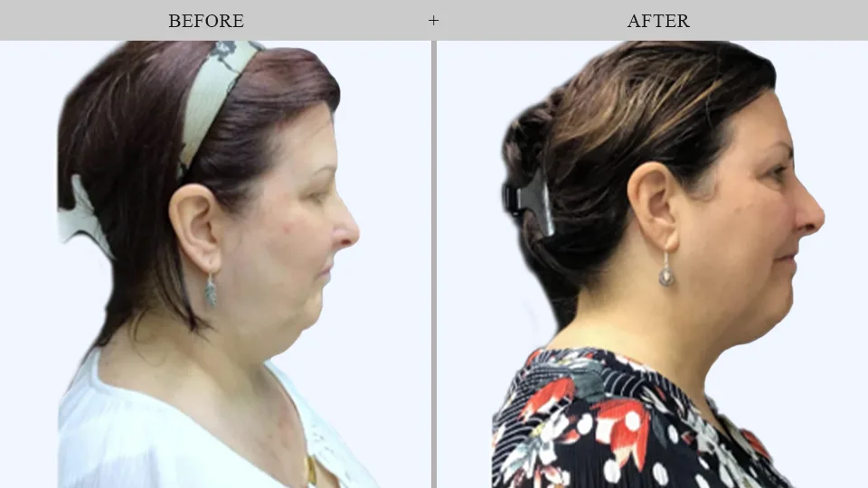 Результаты Botox до и после в Форест-Хиллс