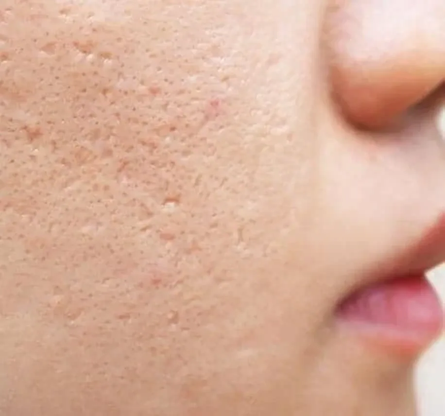 Acne scar treatment at Adult and Pediatric Dermatology Queens
