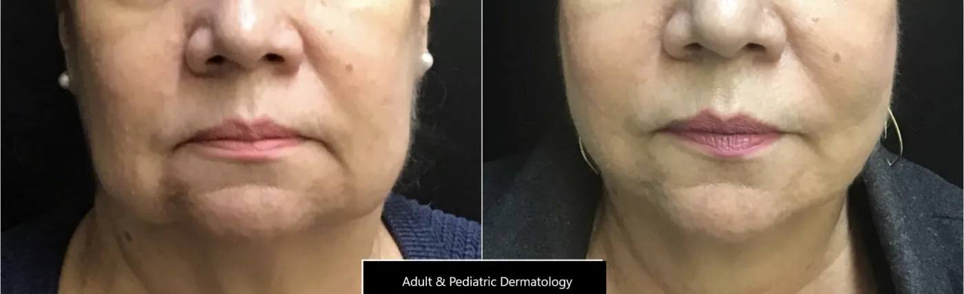 Thread lift non-surgical face lifting treatment in Queens NY