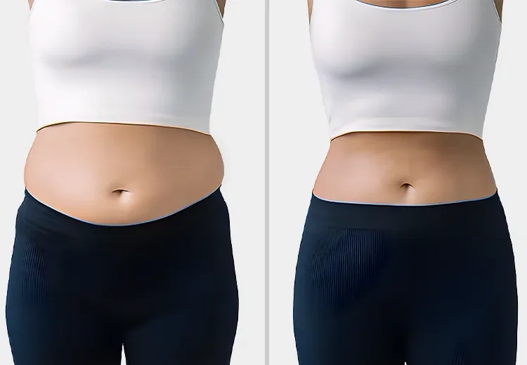 CoolSculpting до и после, пример 2