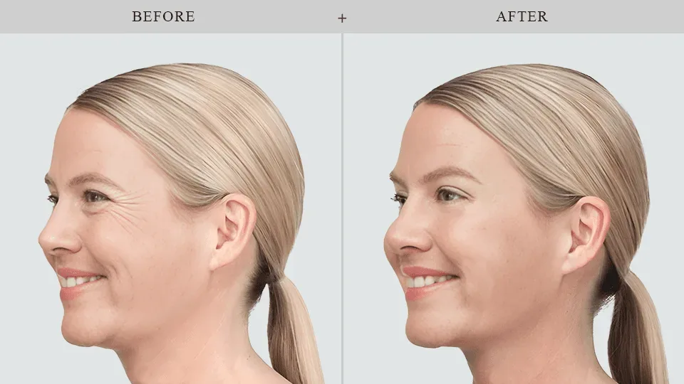Результаты Botox до и после в Куинсе