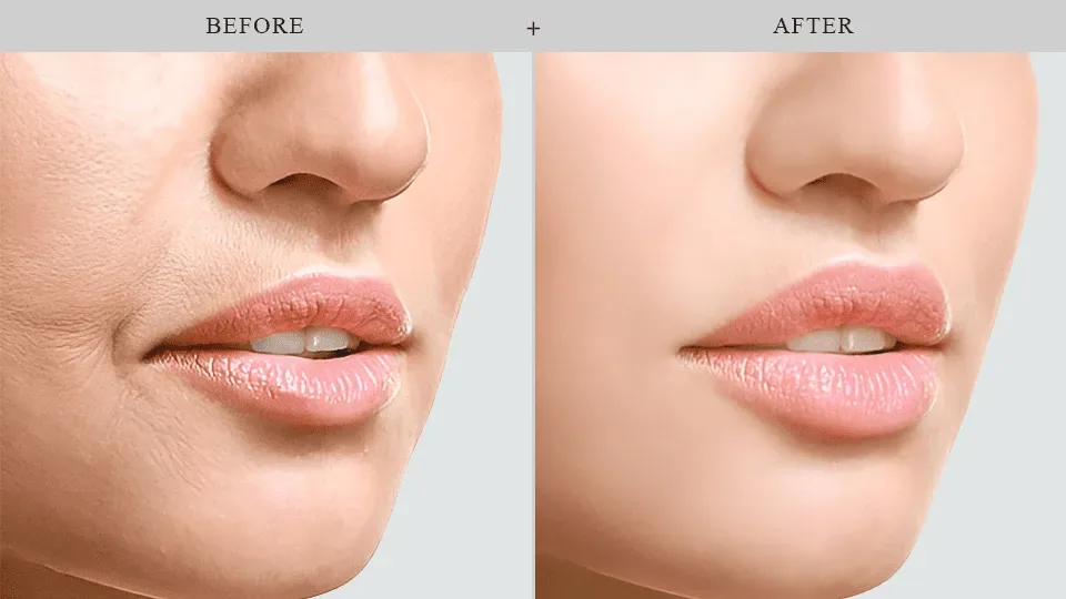 Результаты Botox до и после