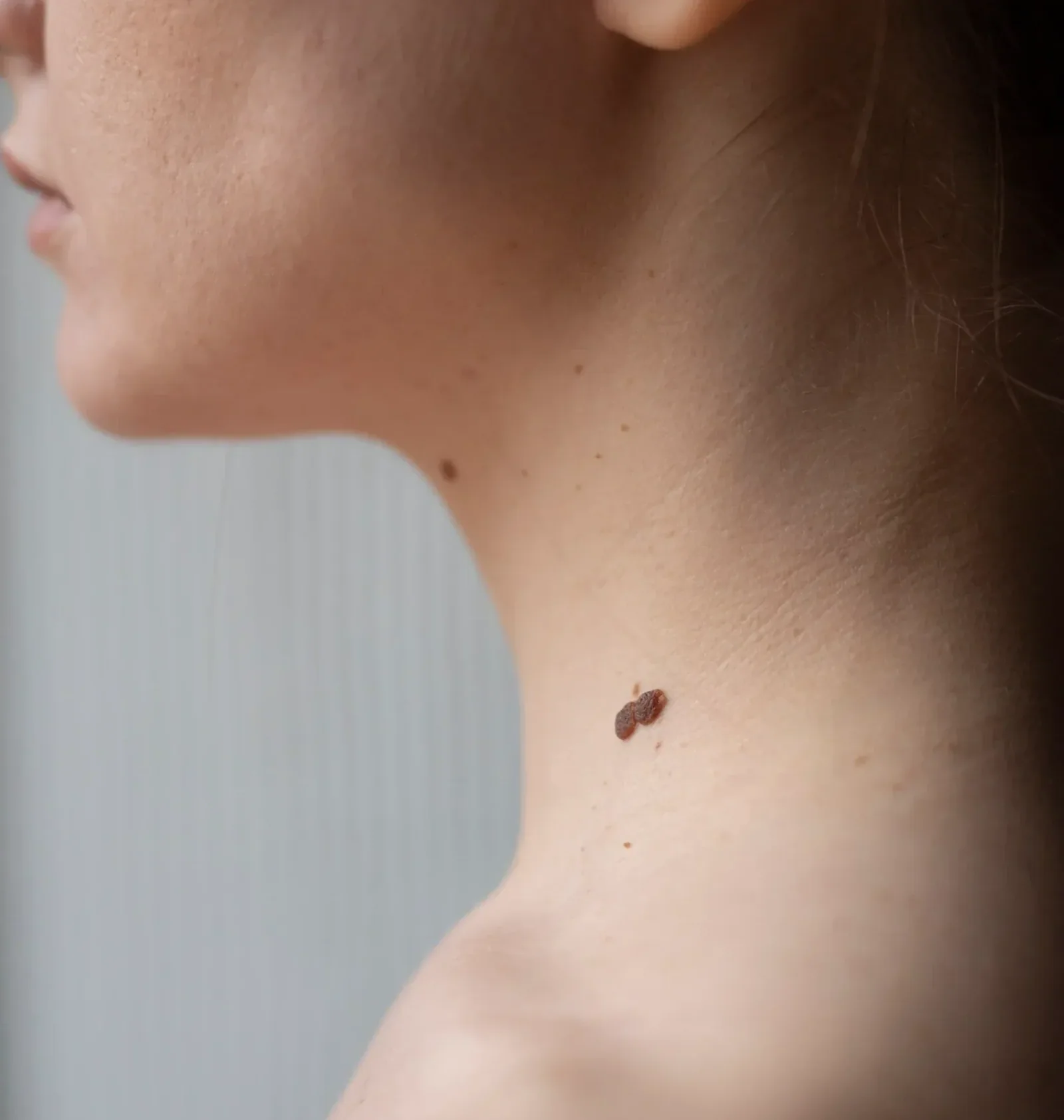 woman-with-melanoma-her-skin