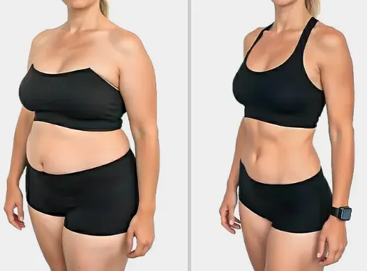 Does CoolSculpting Work?
