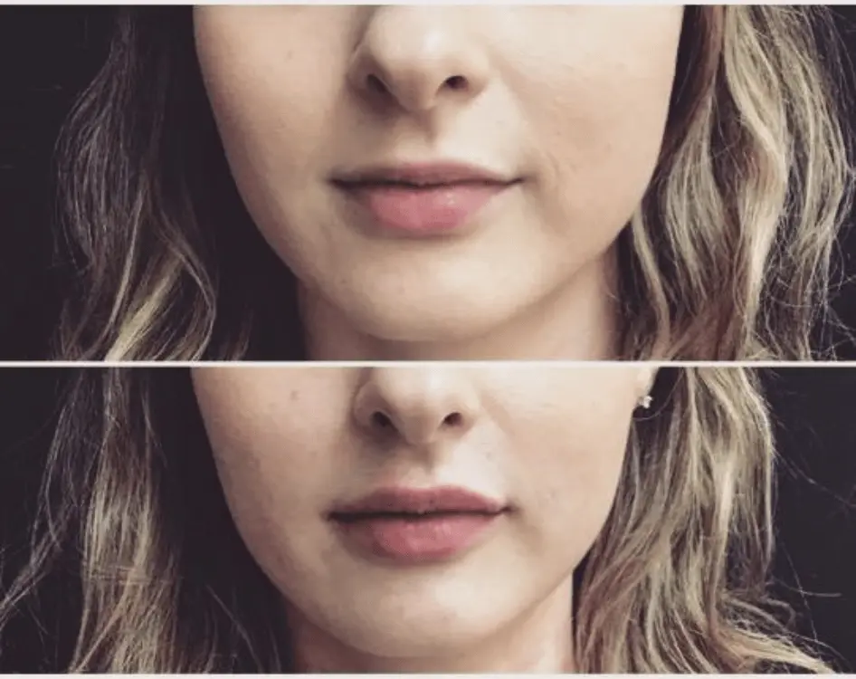 Smile Line Fillers Before and After: Transforming Your Smile with Dermal Fillers
