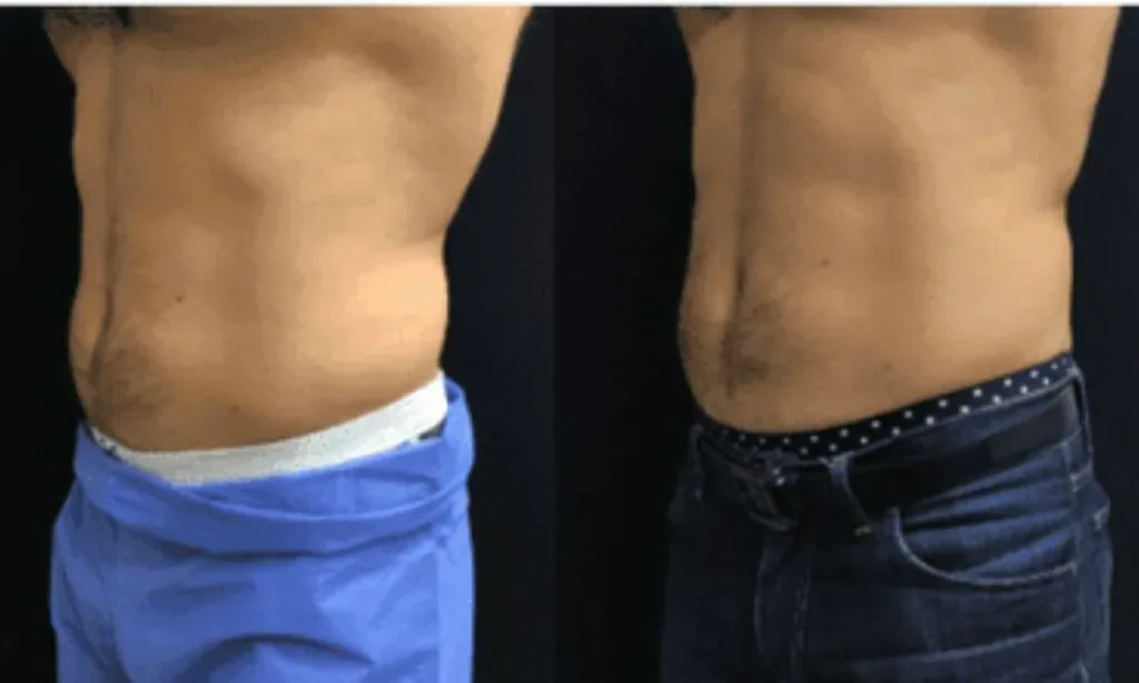 Ideal Candidates For Emsculpt
