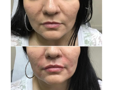 Fillers Treatment Queens NY