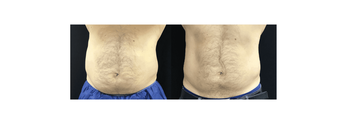 Where to Get CoolSculpting in Queens, NY, Coolsculpting Queens