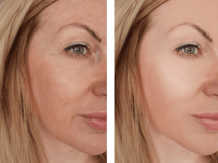 Fillers For Under Eye Wrinkles Before and After