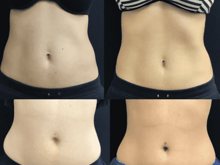 Stomach Skin Tightening Treatments - The Ultimate Guide