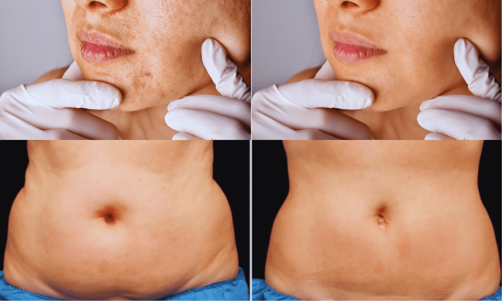 What Areas Can You Have Treated with Coolsculpting®