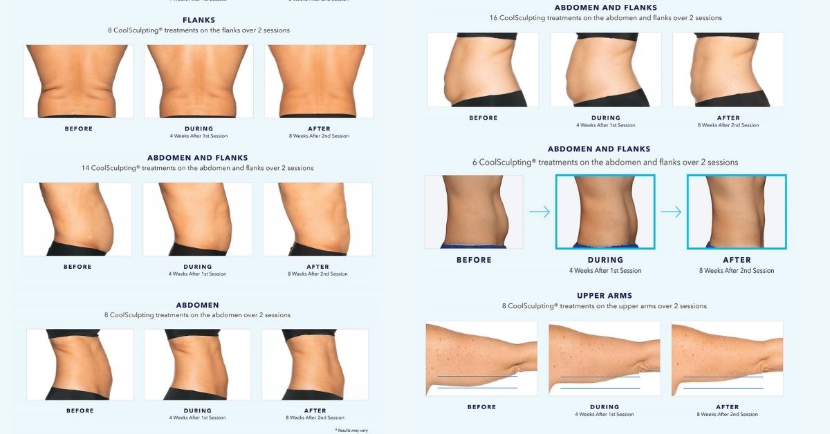 Where to Get CoolSculpting in Queens, NY Coolsculpting Queens Coolsculpting Near Me