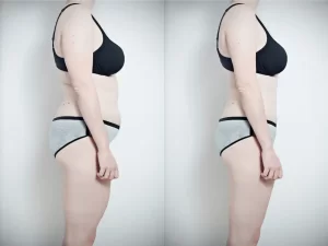 Emsculpt Before and After: An Effective Body Contouring Treatment