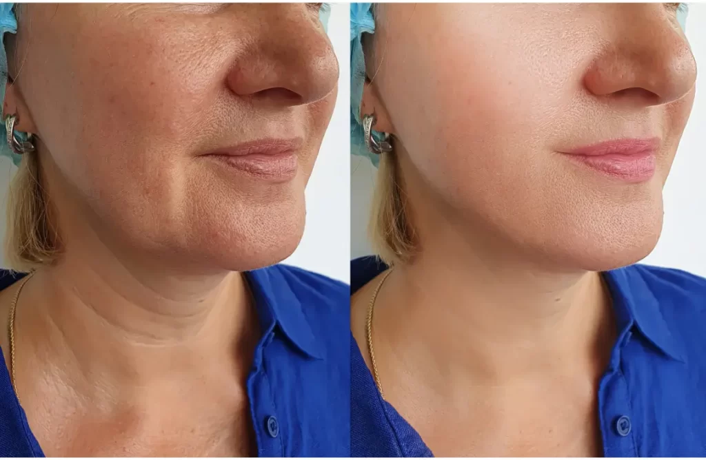 juvéderm fillers before and after
