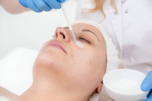 Can Chemical Peels Effectively Treat Dark Spots