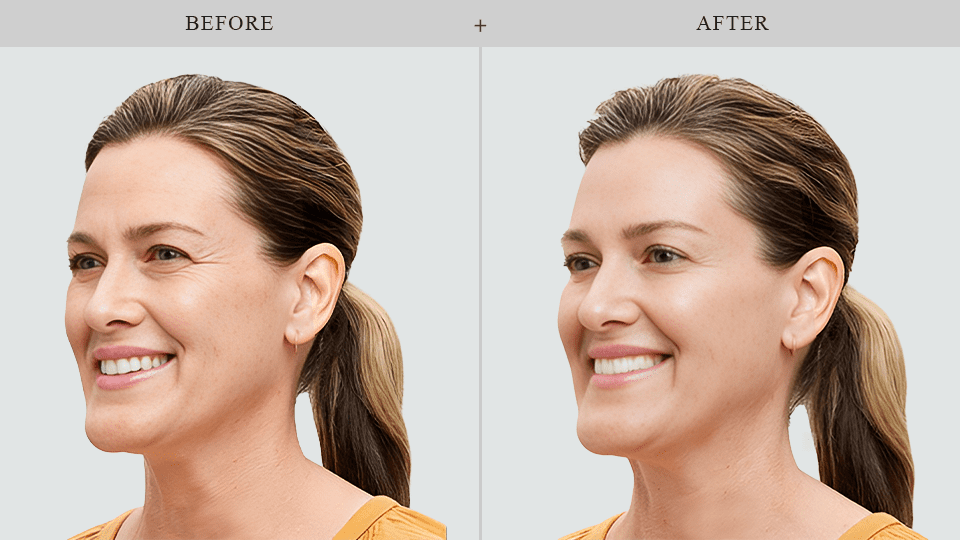 botox results