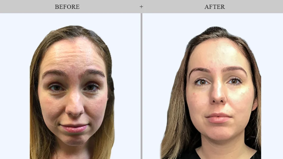 botox results