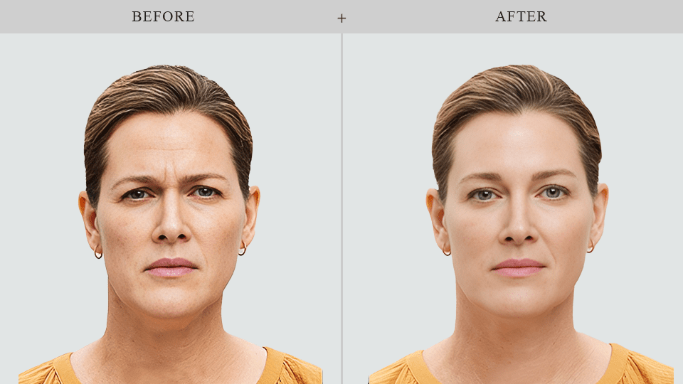 botox before and after results in forest hills