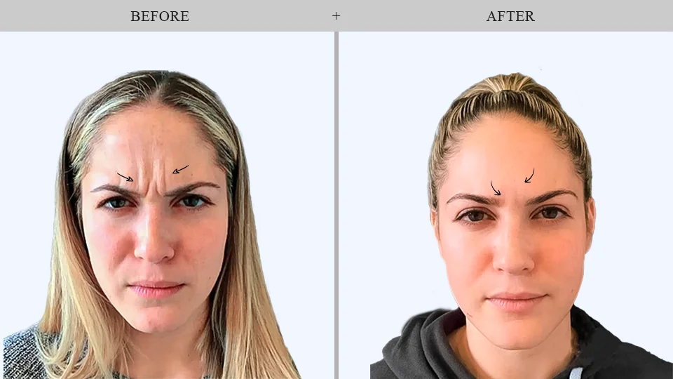 botox before and after results in forest hills