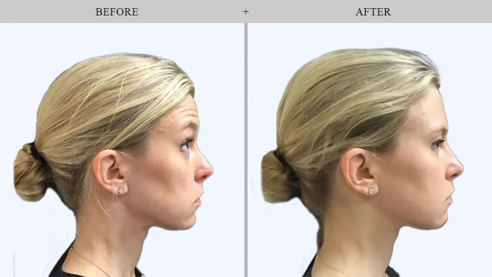 botox before and after results in queens