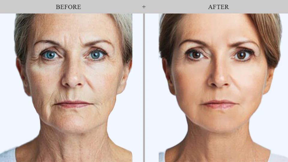 botox before and after results