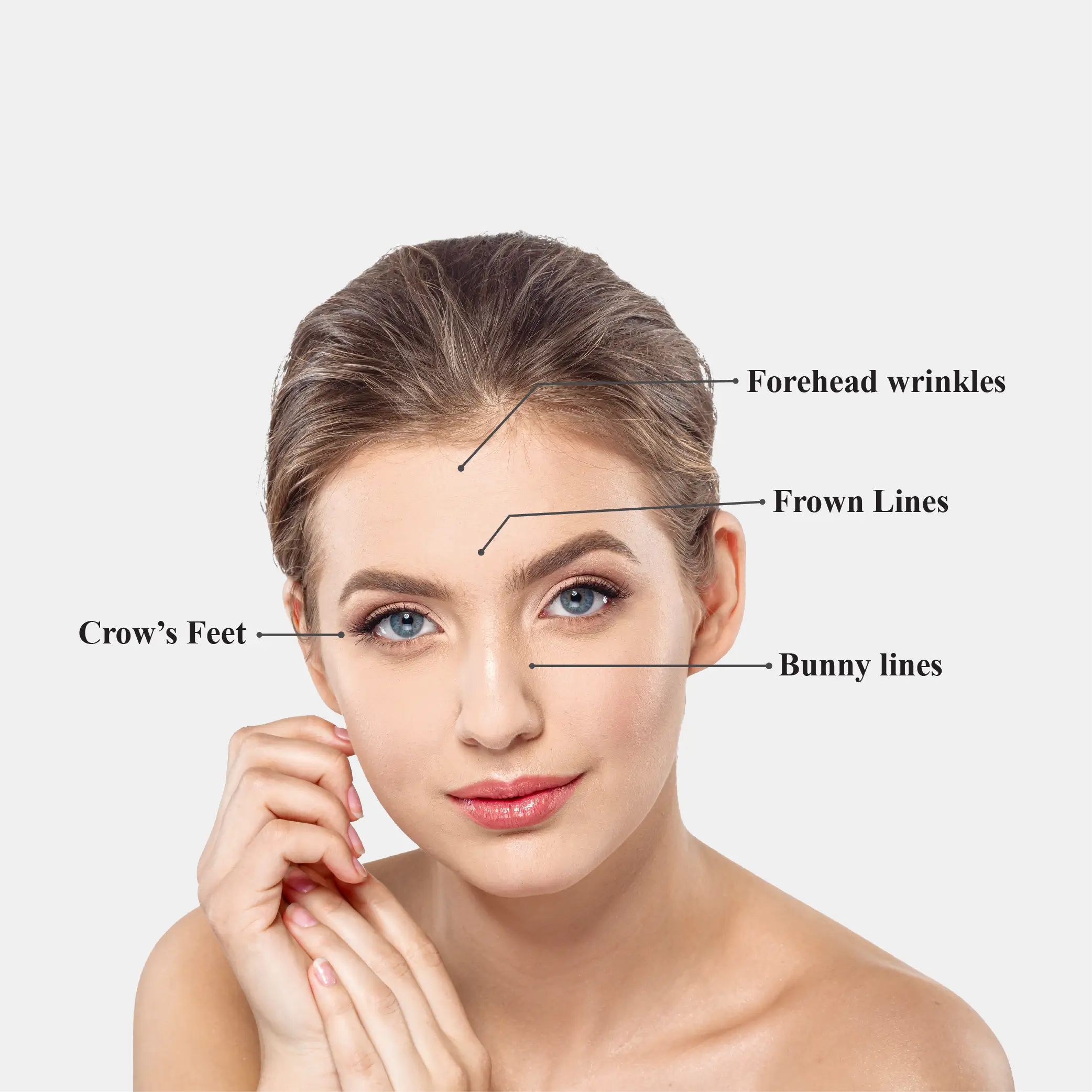 Botox areas treated