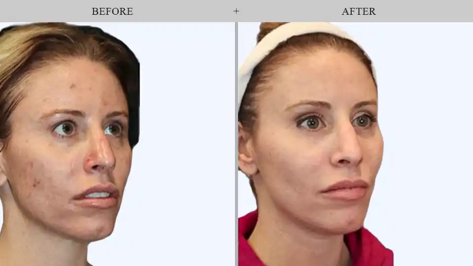 facials treatment in queens