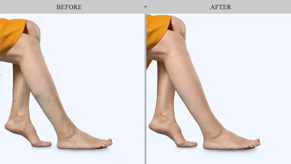 vein treatment results