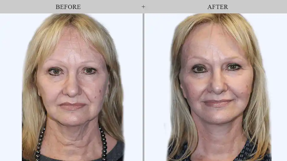 Thread Lift before and after results