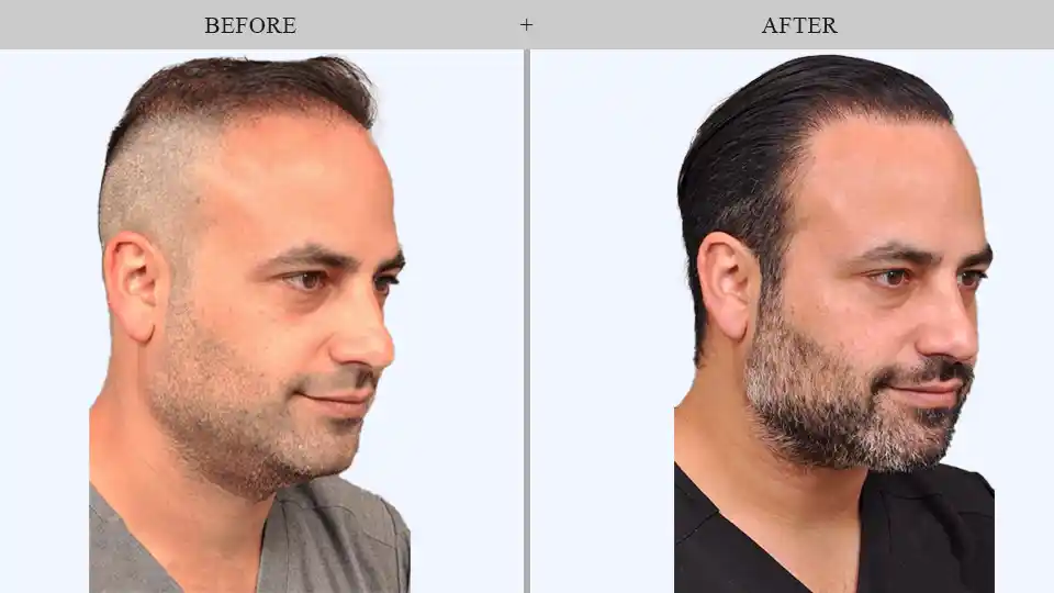 skin tightening before & after results