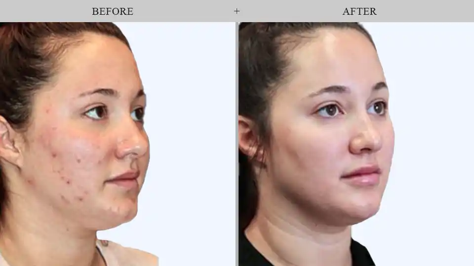 facials treatment before and after results