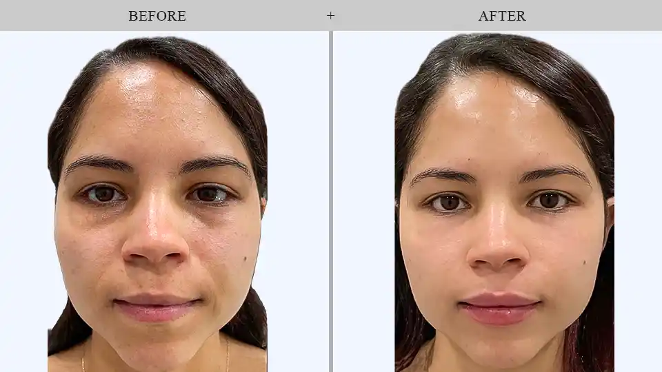 fillers treatment before and after results