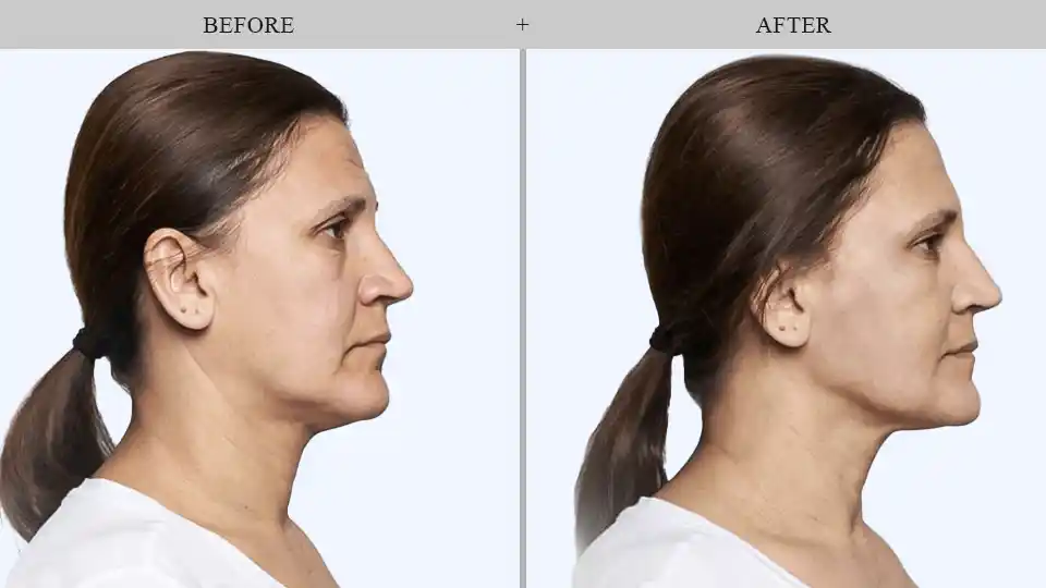 Thread Lift results