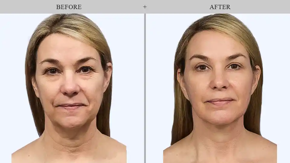 skin tightening in forest hills