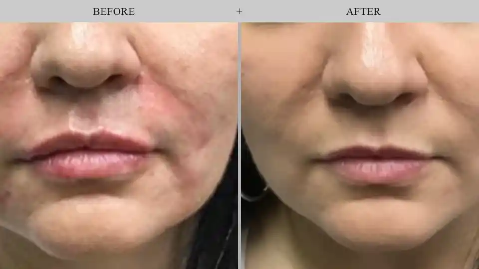 fillers before and after results