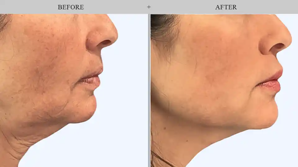 Thread Lift treatment results