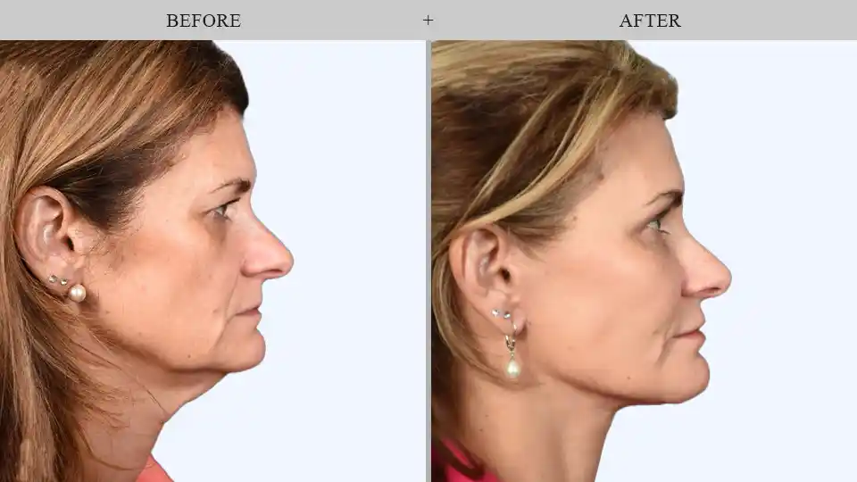 skin tightening