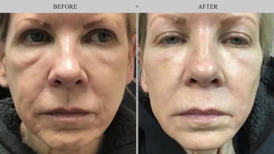 fillers before and after
