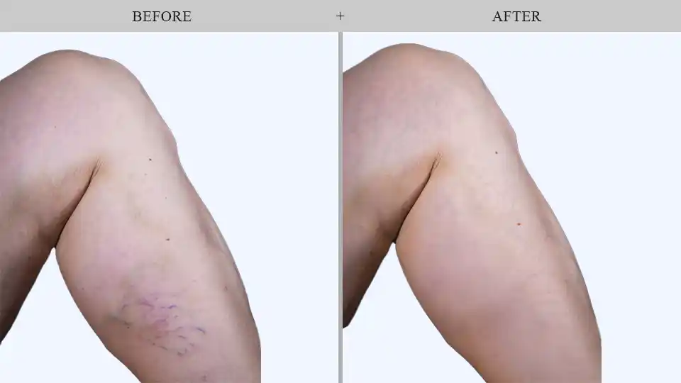 Vein Treatment before and after