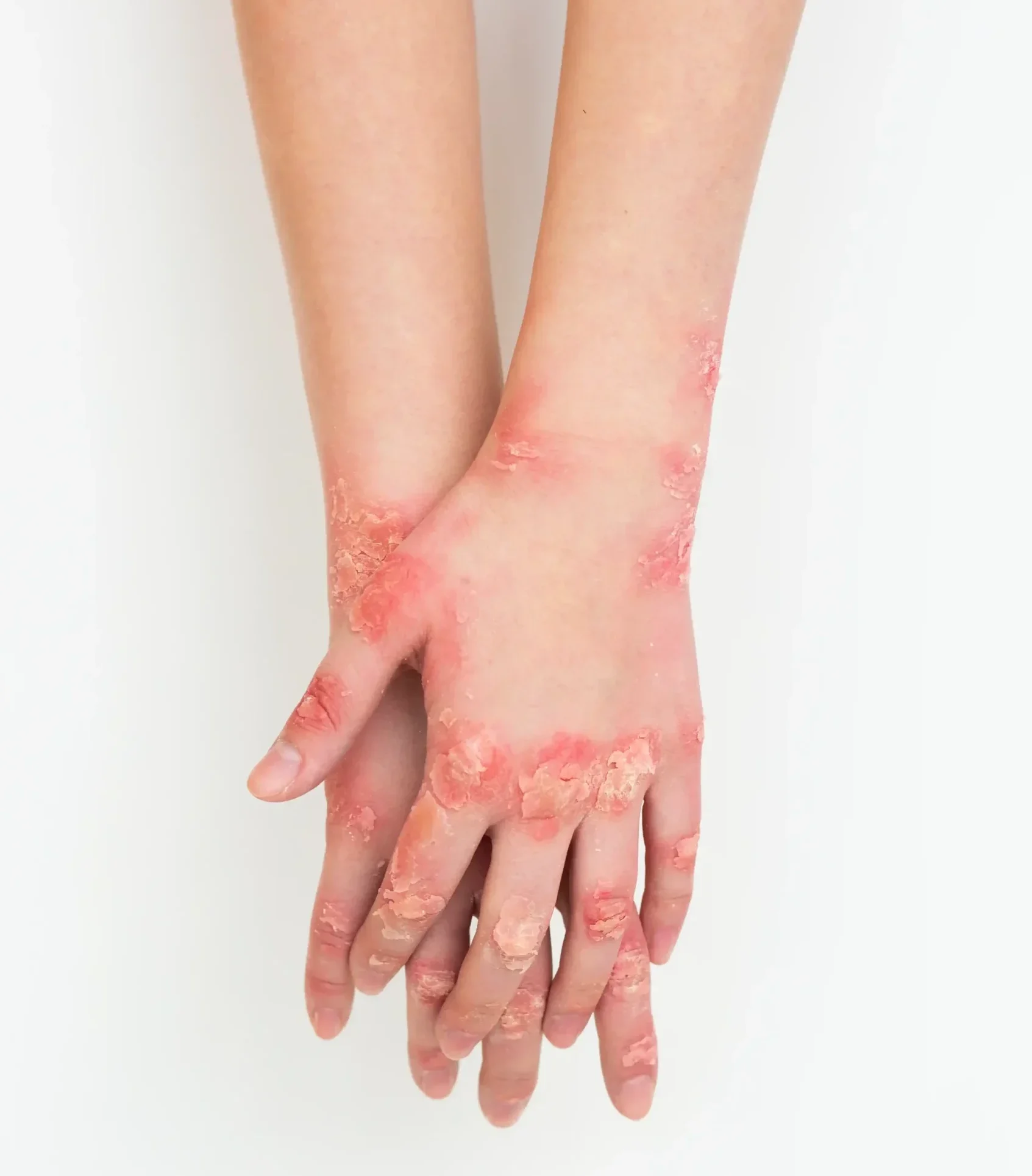 hands-patient-suffering-from-psoriasis (1)