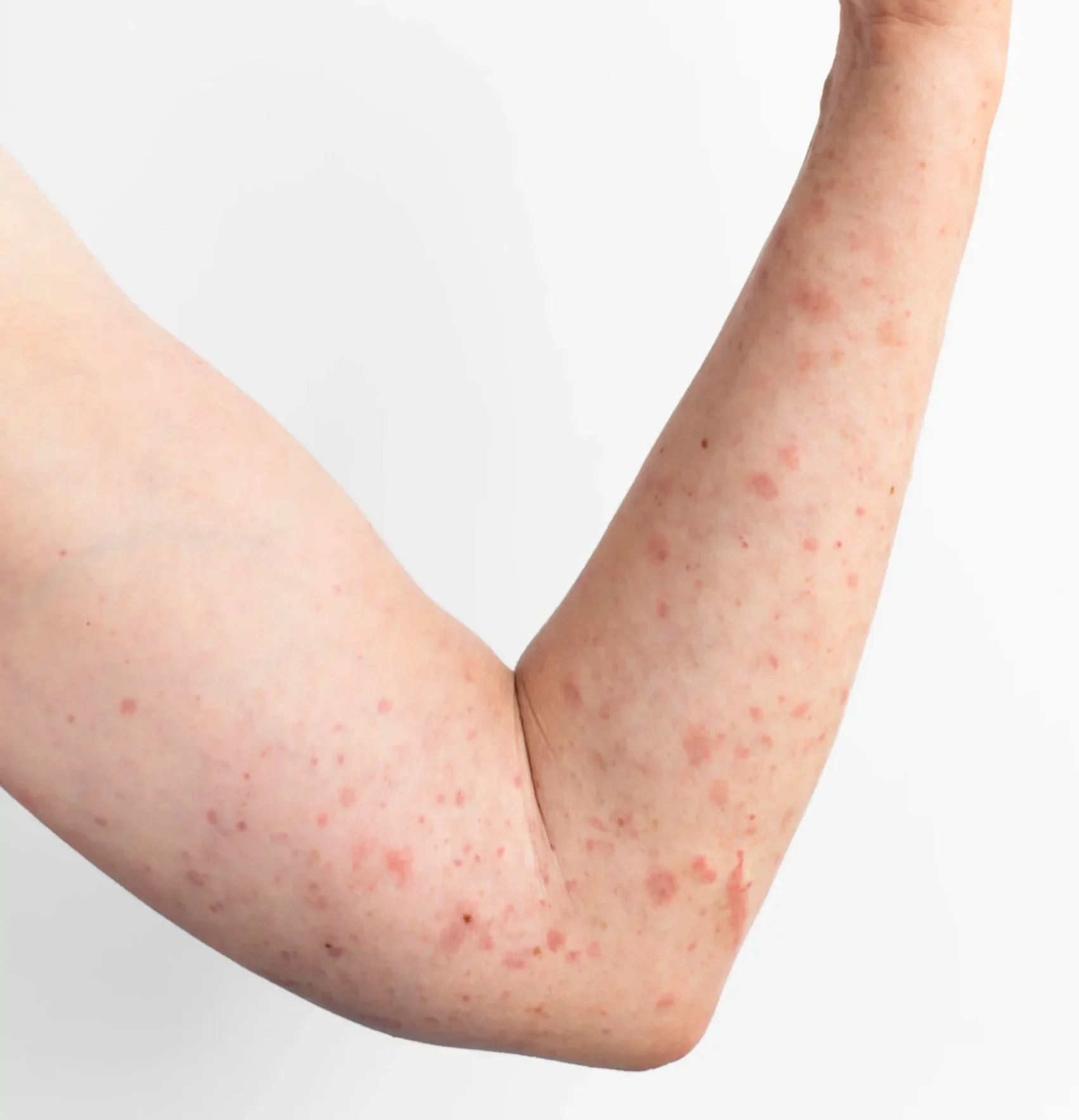 skin-allergy-reaction-test-person-s-arm